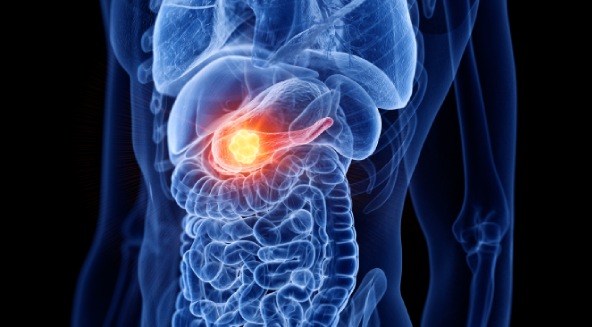The Key Point in Pancreatic Cancer Treatment is Early Diagnosis.